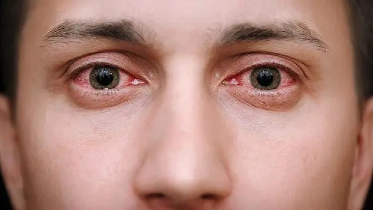 Water Is Coming Out With Burning Sensation In The Eyes, Treat It With These Easy Methods