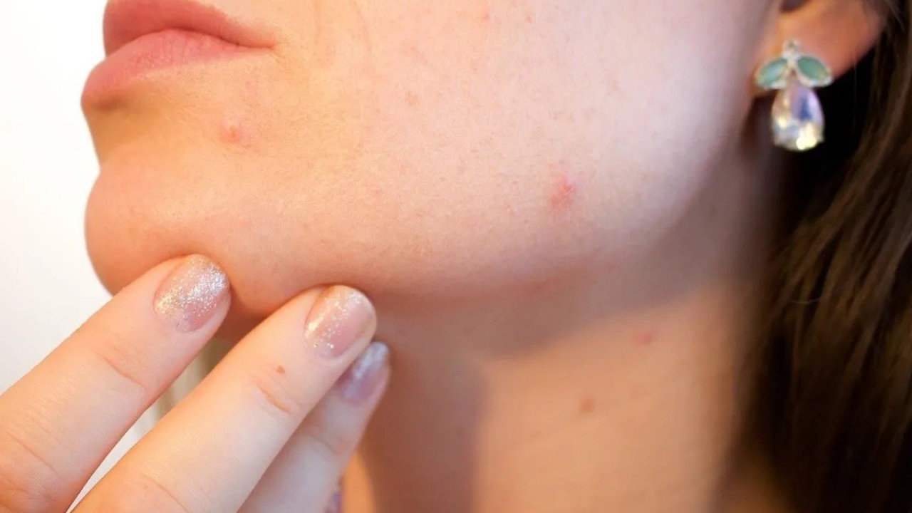 Vitamin B12 Deficiency Also Affects The Skin, These Problems Related To The Skin Can Be Symptoms